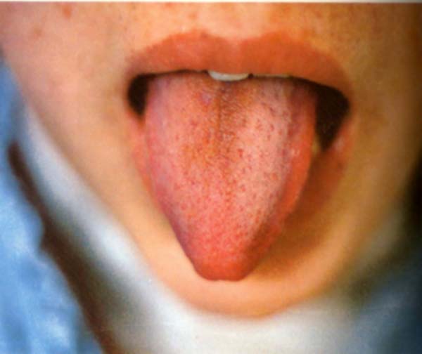 红舌薄白灰干苔