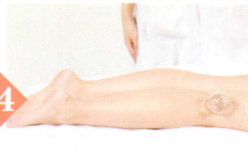 类风湿性关节炎拔罐部位图解