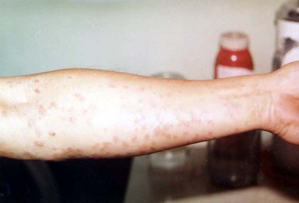 中医望皮肤之红斑1