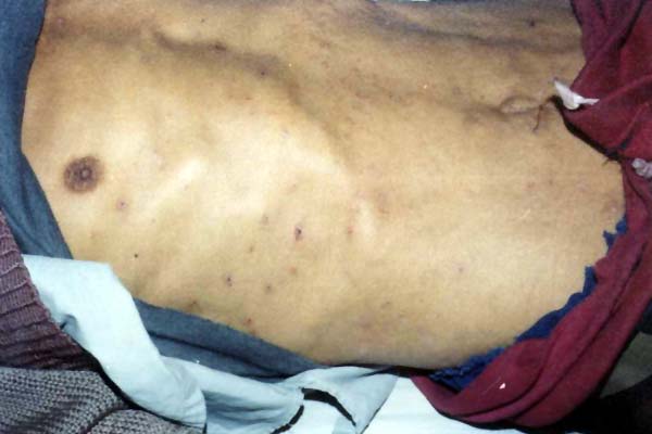 中医望皮肤之腹部凹陷、带状疱疹