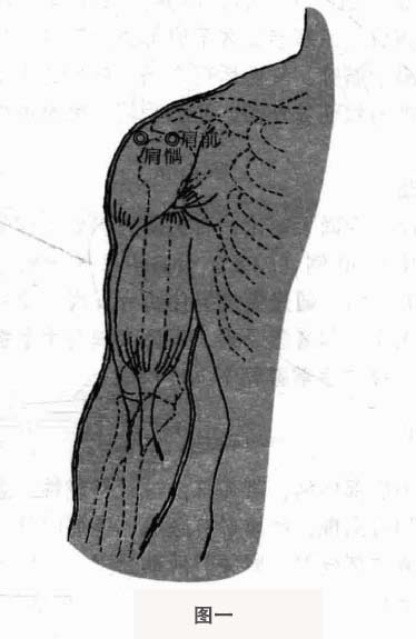 肩周炎钩针疗法