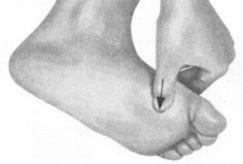 高脂血症按摩部位图解