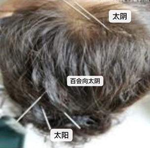 传承三阴三阳开阖枢理论创新针法