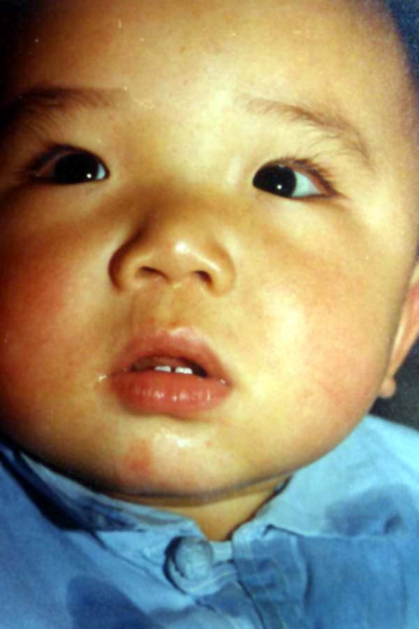 中医望色之赤(面红浮散,外感风寒面容)