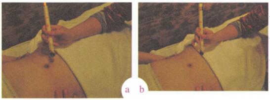 中风艾灸哪个部位图解