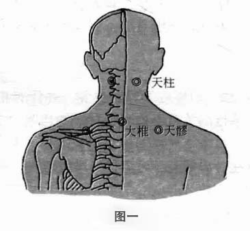 颈椎病钩针疗法