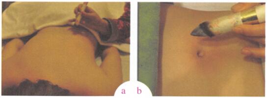 盆腔炎艾灸哪个部位图解