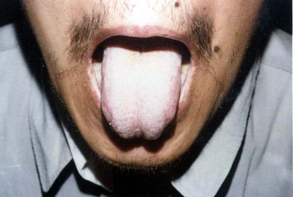 中医望皮肤之扁平疣2