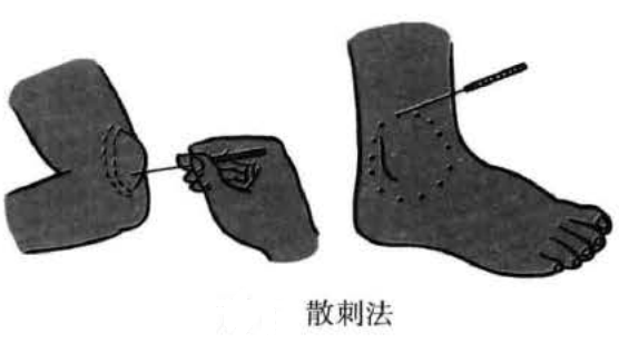 三棱针的操作方法