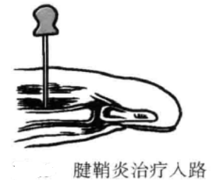 小针刀操作手术入路