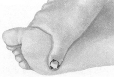 腰椎间盘突出症按摩部位图解