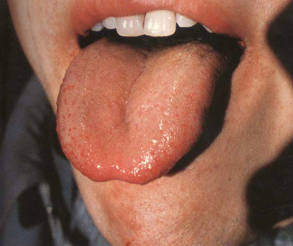 红舌红点白腻苔（红星舌）2