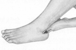 肩周炎按摩部位图解