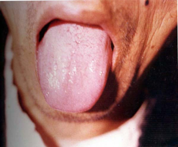 淡红舌白滑腻苔