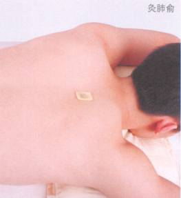 慢性支气管炎艾灸哪个部位图解