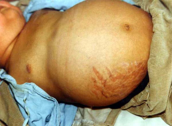 中医望肢体之腹膨隆