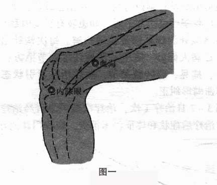 膝关节炎钩针疗法