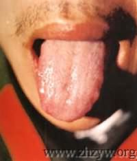 淡红齿痕舌薄白滑润苔1