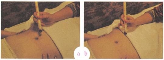 子宫肌瘤艾灸哪个部位图解