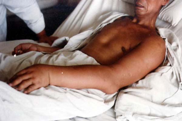 中医望肢体之肢肿手肿