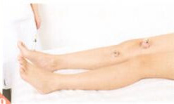 强直性脊柱炎拔罐部位图解