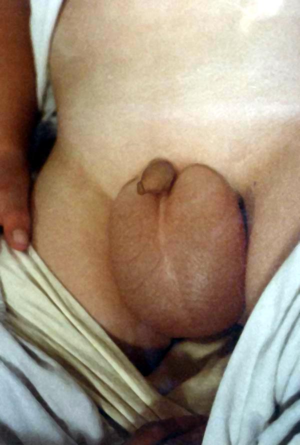 中医望二阴之阴囊水肿