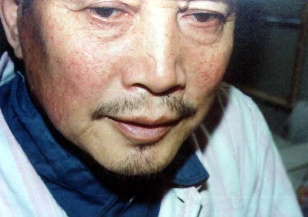 中医望色之面颊血丝红缕