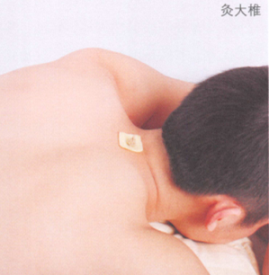 颈椎病艾灸哪个部位图解