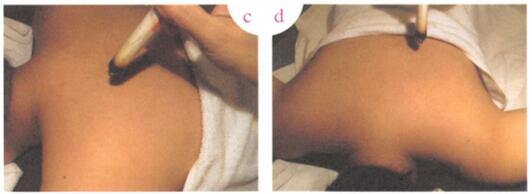 风寒感冒艾灸哪个部位图解