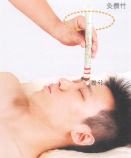 假性近视艾灸哪个部位图解