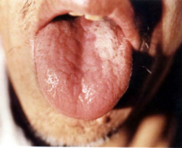 淡红舌偏白腻苔2