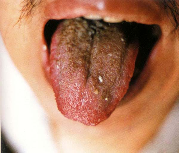 红绛舌红点灰黑垢腻苔