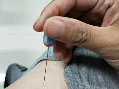 小针刀对软组织劳损及骨关节病变疗效显著