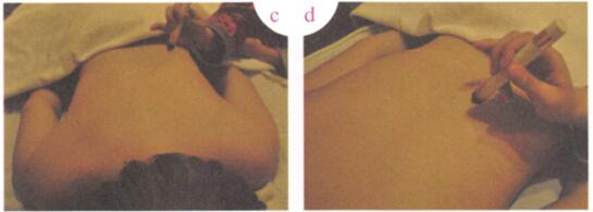 防治酒槽鼻艾灸哪个部位图解