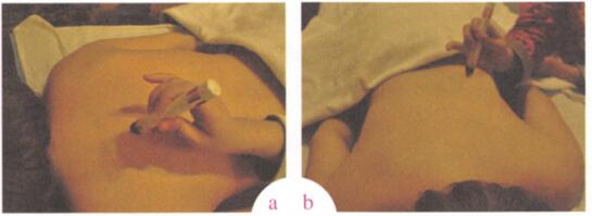 防治酒槽鼻艾灸哪个部位图解