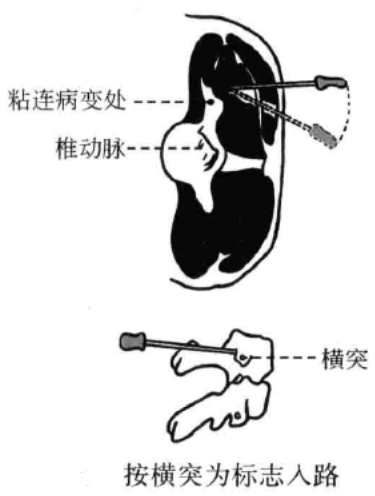 小针刀操作手术入路