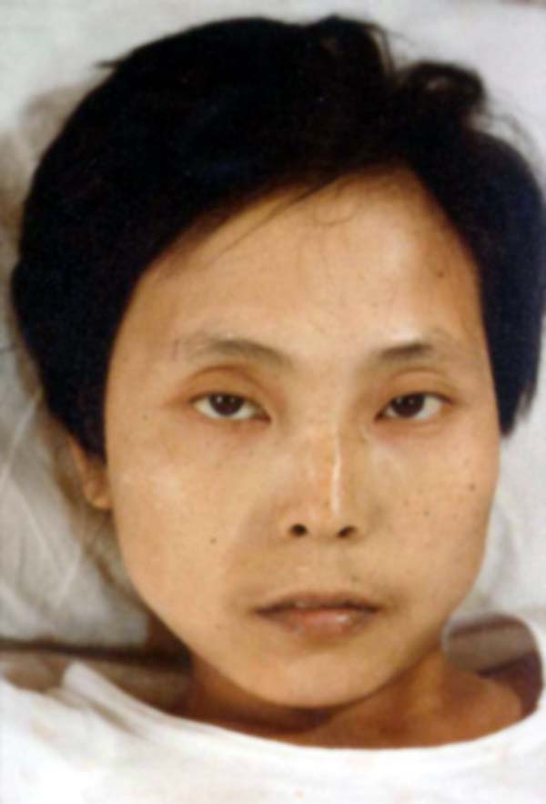 中医望神之重病失神