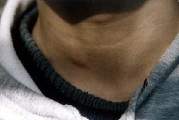 中医望皮肤之颈部疖子