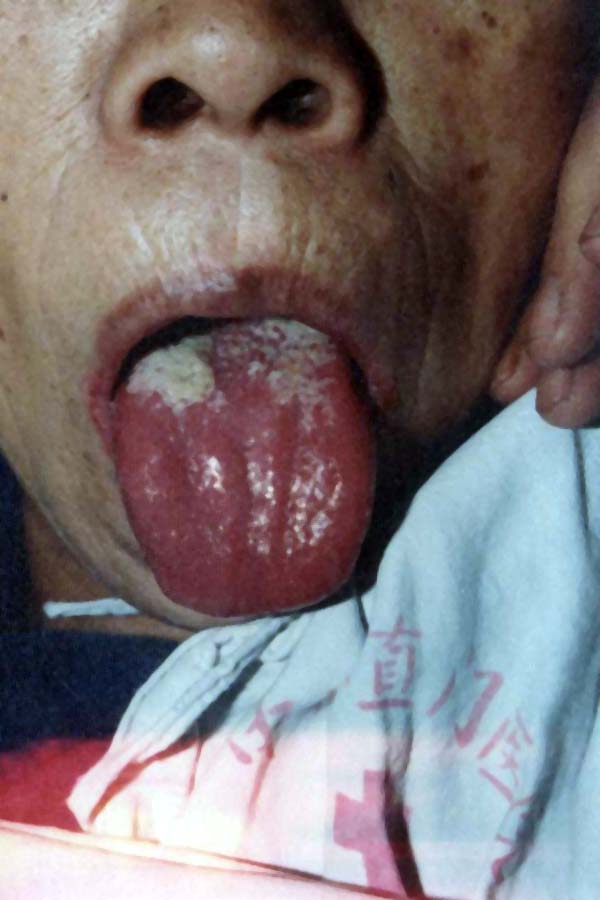 中医望鼻之鼻孔干燥