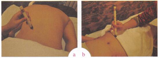 小儿遗尿艾灸哪个部位图解