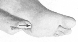 风湿病按摩部位图解