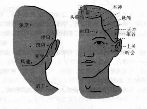 偏头痛磁圆梅针疗法