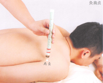 肩周炎艾灸哪个部位图解