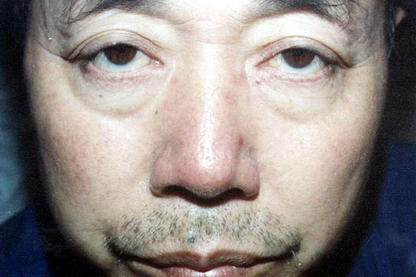 中医望鼻之准头赤