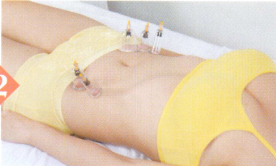 急性阑尾炎拔罐部位图解