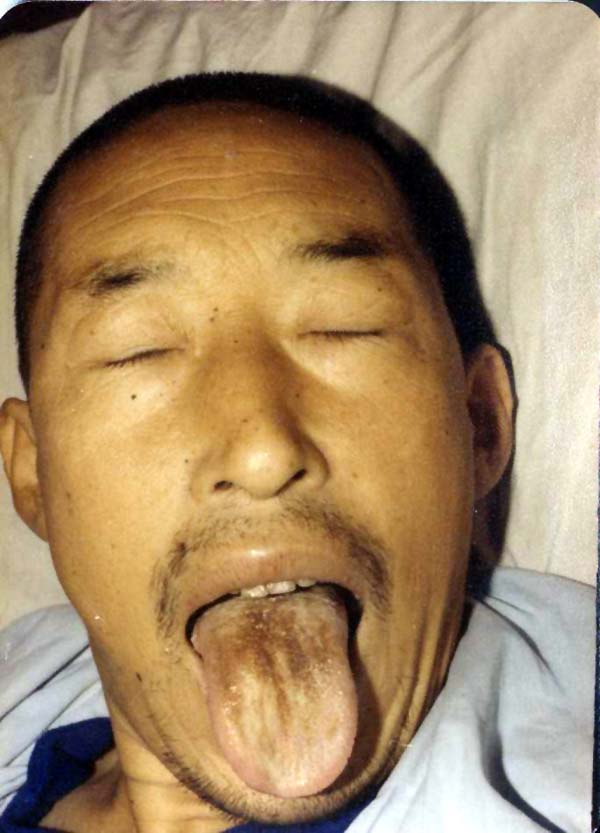 中医望皮肤之面黄色浊，阴黄