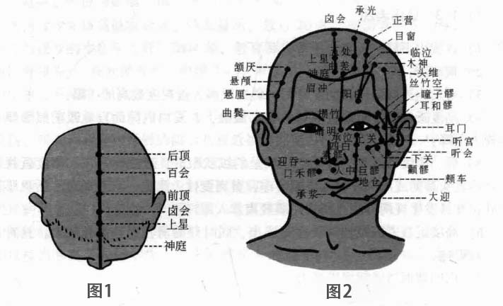 近视磁圆梅针疗法