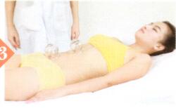 梅尼埃综合征拔罐部位图解