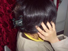 偏头痛的针灸治疗