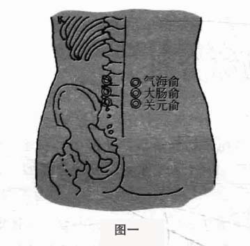 腰椎间盘突出症钩针疗法